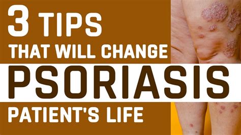 3 Tips That Will Change Psoriasis Patients Life Psoriasis Treatment