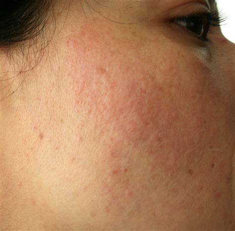 Heat Rash On Face Demodex Mites The Microscopic Epidemic That Will