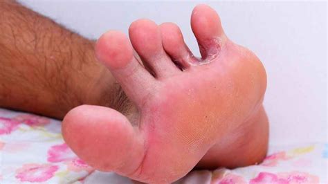 9 Easy Ways To Heal Athletes Foot Health Gadgetsng