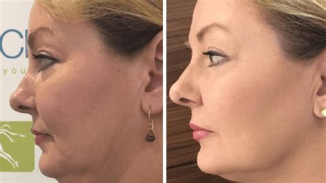 Hifu Non Surgical Body Contouring And Facelift Achieve Your Desired Look