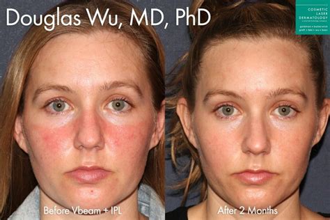 Treating Rosacea With Ipl Cosmetic Laser Dermatology Skin Specialists In San Diego