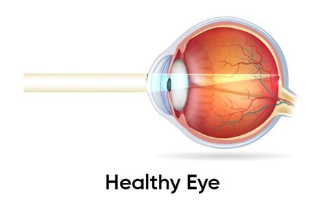 Hyperopia Farsightedness Causes Symptoms And Treatment Browser Scene