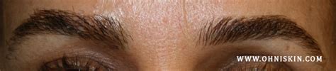 Skin Cancers Involving The Eyebrow Clinical Considerations