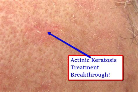 Actinic Keratosis Treatment Breakthrough Youtube