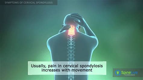 Cervical Spondylosis Symptoms Youtube
