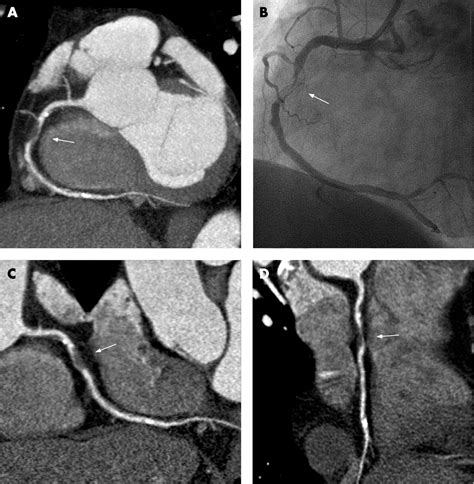 64 Slice Ct Coronary Angiography In Patients With Non St Elevation