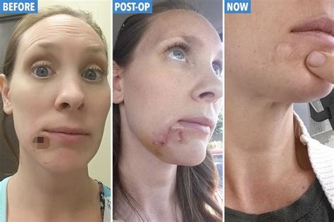 Mum Of Five Left With A Gaping Hole In Her Chin After Dismissing Deadly