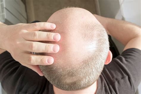 Combat Male Pattern Baldness With These Hair Loss Treatments