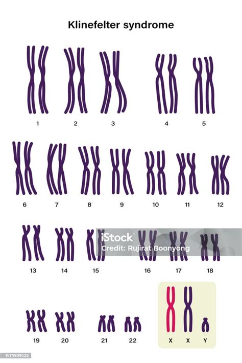 Human Karyotype Of Klinefelter Syndrome Klinefelters Ks Or Xxy Stock