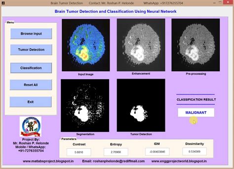 Brain Tumor Detection And Classification Using Neural Network Matlab