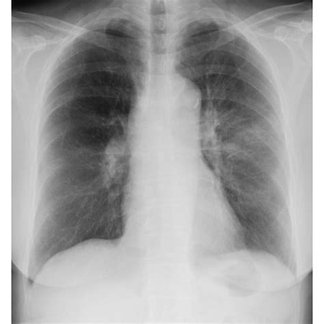 Pdf A Case Of Pulmonary Infarction Resembling Pneumonia During