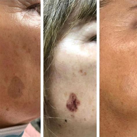 Brown Spots Removal Age Spot Treatments