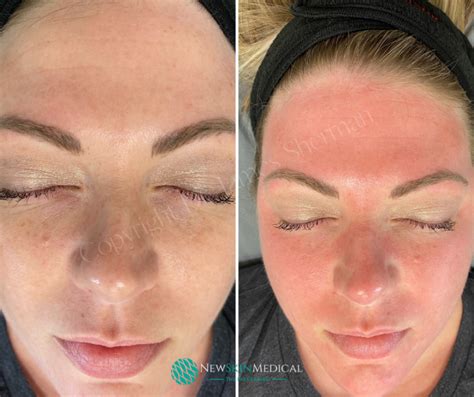 What To Expect After A Virtue Rf And Coolpeel Laser Treatment