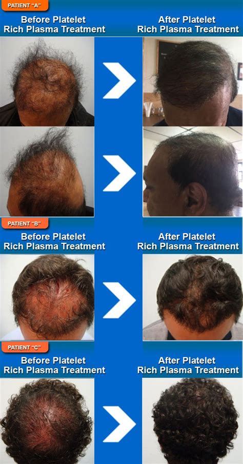 Learn more about natural ways to improve your condition. Platelet Rich Plasma Treatment For Hair Loss in Toronto