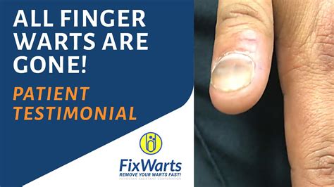 All Finger Warts Are Gone Patient Testimonial Youtube