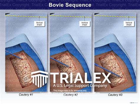 Bovie Sequence Trialexhibits Inc