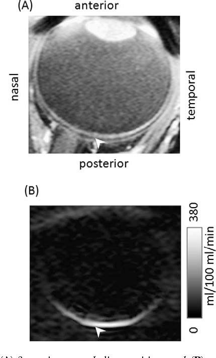 Figure From Blood Flow Mri Of The Human Retina Choroid During Rest