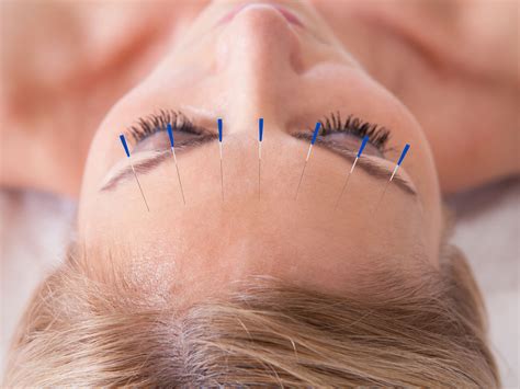 Acupuncture May Help Reduce Tension Headaches Andrew Weil Md