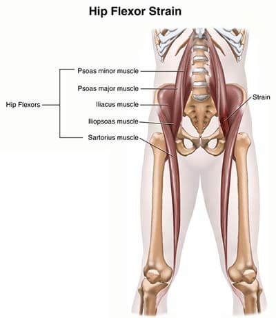 If left unstretched, shortened hip flexors affect the position of the pelvis, which in turn affects the position and movement of the lower back. Hip Flexor Strain Treatment Doctors (Hip Pain Specialists ...