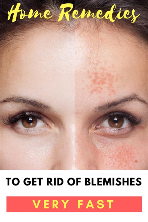 Home Remedies To Get Rid Of Blemishes On The Face Blemish Remedies