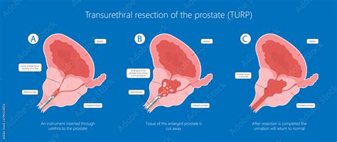 transurethral resection of the prostate stricture urine bladder digital rectal exam specific