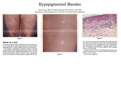 Jama Network Jama Dermatology Hypopigmented Macules
