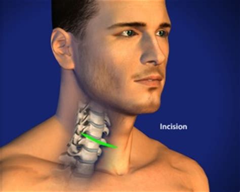 Anterior Cervical Discectomy And Fusion Intervertebral Spacer
