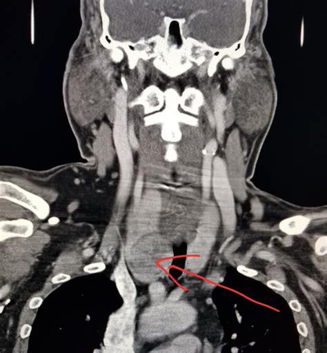 Neck Ct Thyroid Nodule In Patient With A Palpable Lump