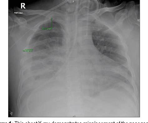 Figure 1 From Pneumothorax After Insertion Of Nasogastric Tube