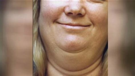 Fda Considers Injection To Dissolve Double Chin Abc7 San Francisco