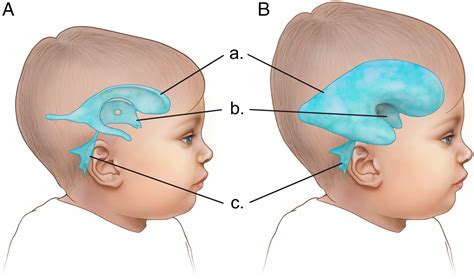 Hydrocephalus Symptoms And Causes