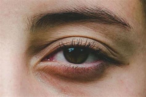 Why Do Bags Appear Under The Eyes Causes Of Bags Under The Eyes And