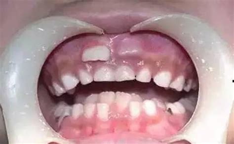 揭秘孩子為什麼長出兩層牙齒的？ 每日頭條