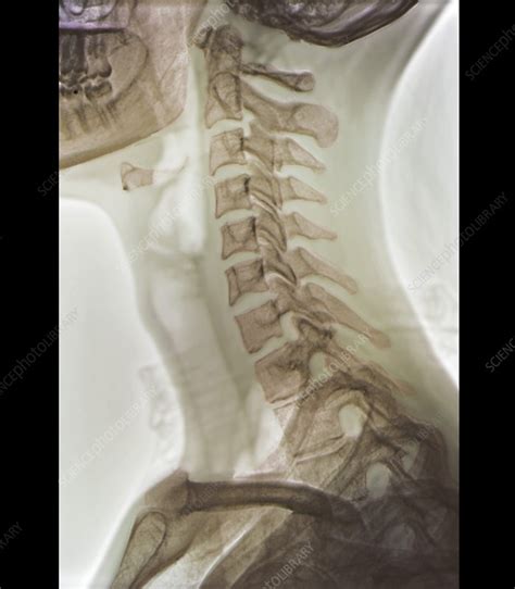 Normal Neck X Ray Stock Image F0033500 Science Photo Library