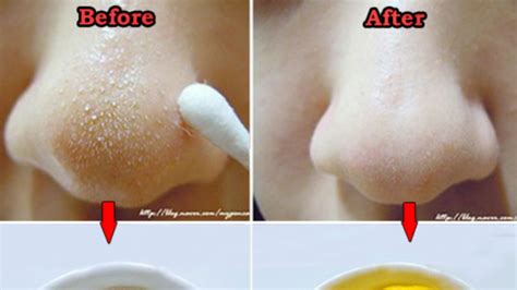 Get Rid Blackheads Nose Blackheads On Nose Homemade Beauty Tips