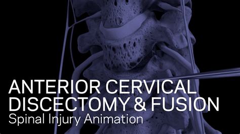C5 6c6 7 Anterior Cervical Discectomy With Fusion Youtube