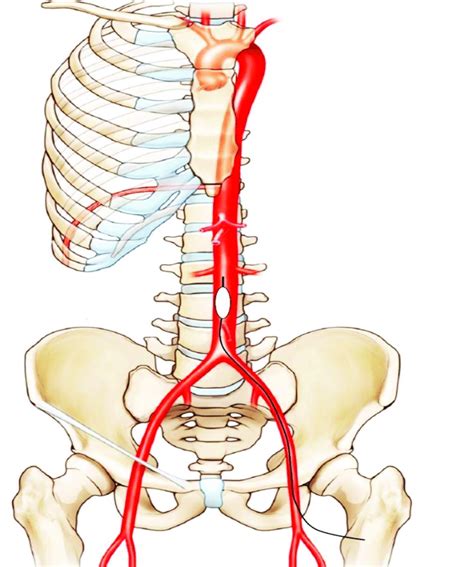 Illustration Of Aortic Occlusion Shows An Infrarenal Resuscitative