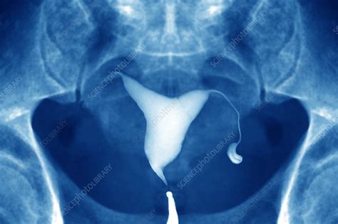 Blocked Fallopian Tube X Ray Stock Image M8500651 Science Photo