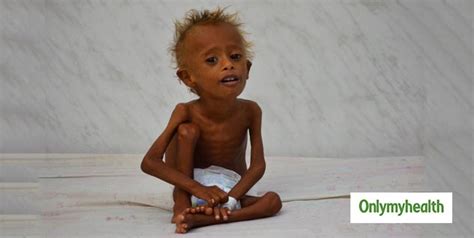 Malnutrition And Death In Children Causes Prevention And More
