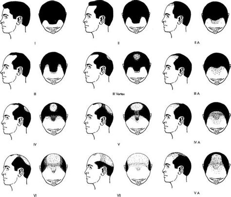 Norwood Scale 7 Stages Chart Causes And Treatment Bald And Beards