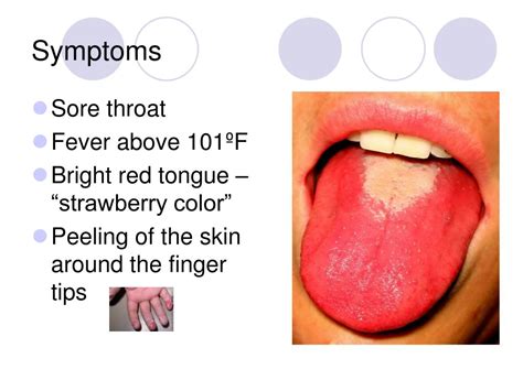 Ppt Streptococcus Scarlet Fever Powerpoint Presentation Free