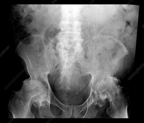 Severe Osteoarthritis Both Hips Stock Image C0034600 Science