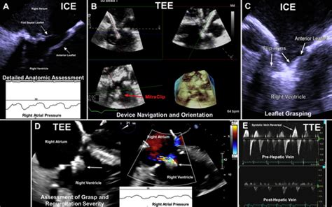 The Dynamic Duo Intracardiac And Transesophageal Echocardiography In