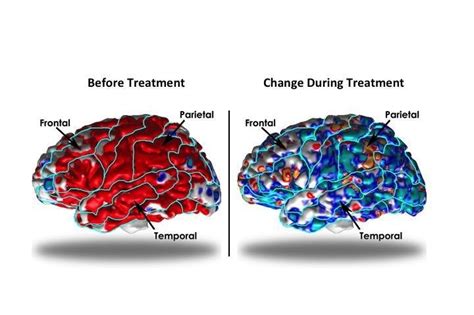 Study Shows Brain Structure Changes During Depression