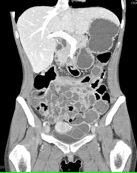 Unsuspected Ulcerative Colitis In A Marfan Patient Colon Case Studies