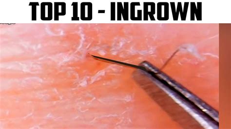 Ingrown Hair Comedone Extractors And Pimple Popping Kits Youtube