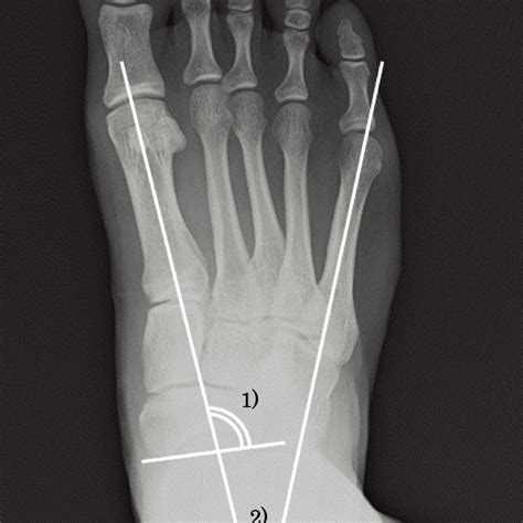 Longitudinal Arch Measurement Angles 1 Lateral Talocalcaneal Angle