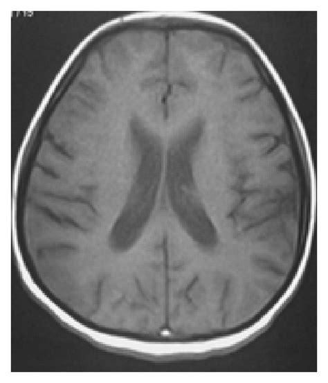 Dural Venous Sinus Thrombosis As An Only Imaging Evidence Of