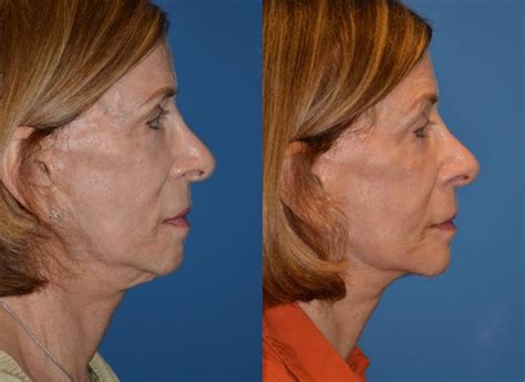Patient 122406485 Laser Assisted Weekend Neck Lift Before And After