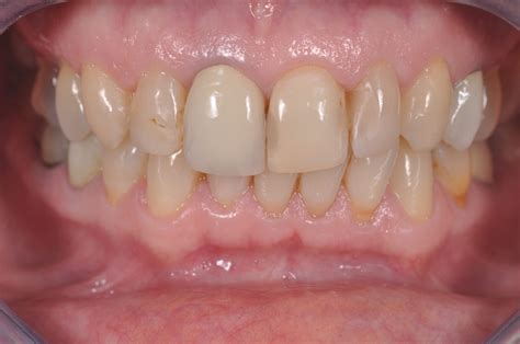 How To Get The Perfect Look With Diverse Tooth Restorations